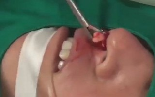 Răng mọc trong lỗ mũi nữ bệnh nhân 38 tuổi