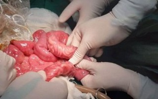 Bác sĩ hoảng hồn khi lấy ra 0,5 kg giun trong ruột trẻ 3 tuổi