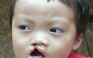 Phẫu thuật miễn phí cho trẻ bị sứt môi trên toàn quốc
