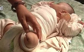 Bé sơ sinh bị cắt chân vì y tá quên tắt máy sấy tóc