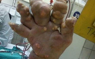 Rợn người hình ảnh bệnh nhân bị biến dạng khớp do mắc gout