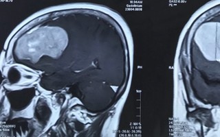 Phẫu thuật thành công u màng não ‘khủng’ cho cụ bà 76 tuổi