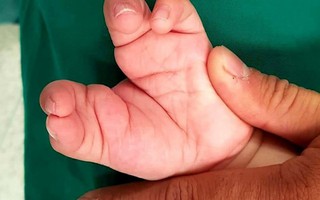 Vừa chào đời, tay chân bé đã dị dạng như càng cua