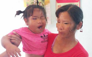 Thanh Hóa: Nghi vấn bé mầm non bị cô giáo đánh méo miệng