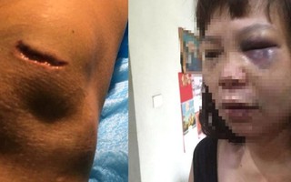 Từ vụ chồng cắt gân vợ ở Quảng Ninh: Phụ nữ cần làm gì để bảo vệ bản thân?