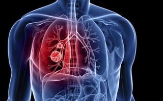 3 trường hợp cần tầm soát ung thư phổi 
