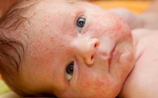Trẻ dễ mắc bệnh ngoài da nào trong mùa hè?