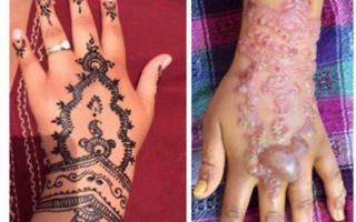 Tay phồng rộp đáng sợ vì xăm henna