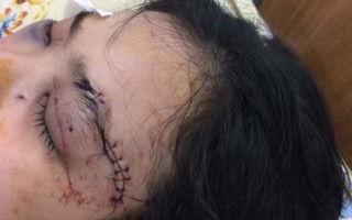 Thiếu nữ bị cắt lìa tai, vỡ giác mạc vì tố giác tội phạm