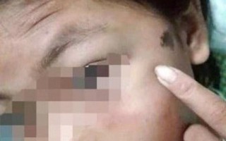 Hội LHPN Hà Tĩnh yêu cầu điều tra, làm rõ vụ bé gái bị công an viên đánh bầm tím