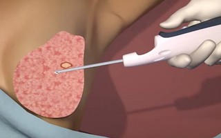 Hơn 200 phụ nữ được sinh thiết u vú bằng kỹ thuật hỗ trợ hút chân không 