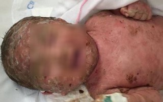 Tắm lá chữa thủy đậu, 2 trẻ 4 tháng tuổi nhiễm độc da toàn thân