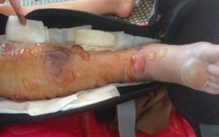 Nữ sinh phải cưa chân vì bệnh viện chủ quan