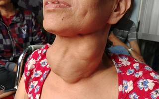 Nữ bệnh nhân bị suy thận mạn vì mang bướu cổ lâu năm