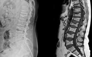 7 bệnh nghiêm trọng sau dấu hiệu của cơn đau lưng