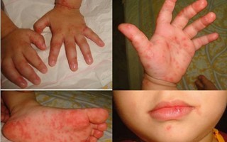 Bác sĩ chỉ rõ dấu hiệu trẻ nhiễm virus tay chân miệng khiến 6 bé tử vong