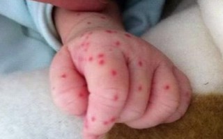 Bệnh nhi sốt xuất huyết tử vong do nhầm thành sốt siêu vi