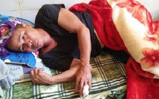 Nghệ An: Đi làm ruộng, một người dân bị lợn rừng cắn đứt ngon tay