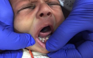 Đứa trẻ sinh ra đã có 7 chiếc răng 