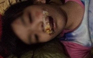 Một bé gái ở Hà Tĩnh bị chó 'điên' lao vào cắn rách mặt