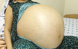 Phép màu với người phụ nữ mang khối u buồng trứng 48 lít 