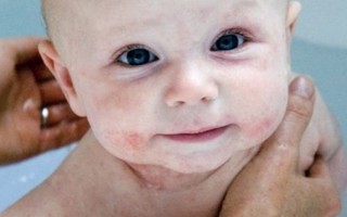 Cách tắm không gây kích ứng da khi bé bị chàm