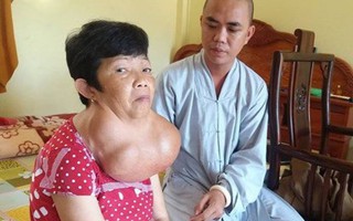 Người phụ nữ 35 năm 'đeo' khối bướu gần 10kg trên cổ