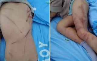 Bé trai 4 tuổi bị mẹ đánh trọng thương do ị đùn 