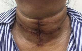 15 năm không điều trị bướu giáp, người phụ nữ phải cắt toàn bộ tuyến giáp