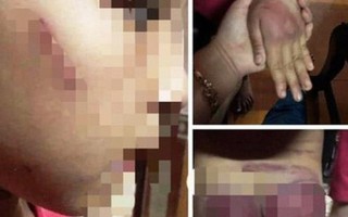 Cơ quan chức năng vào cuộc vụ bố bạo hành dã man con gái 8 tuổi ở Thanh Hóa