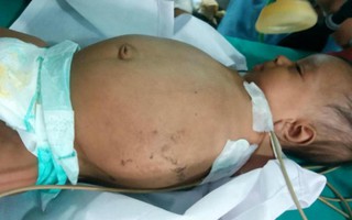Bào thai có mắt và da ký sinh trong bụng bé trai 3 tháng 