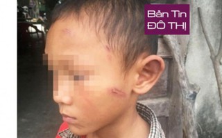 Bé trai 5 tuổi bị dì ruột bạo hành dã man suốt thời gian dài