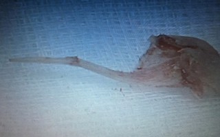 Gắp xương cá lóc hình chiếc dù trong phế quản bệnh nhân