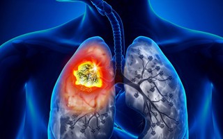9 dấu hiệu của bệnh ung thư phổi bạn cần lưu ý