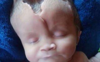 Bé gái 2 tháng tuổi thoi thóp do sọ mở bẩm sinh