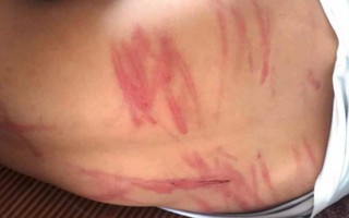 Hà Tĩnh: Nam sinh lớp 8 chằng chịt vết thương nghi bị bố đẻ bạo hành