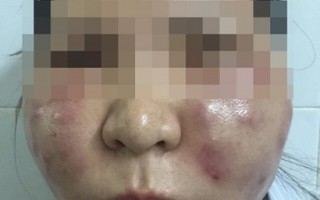 Biến dạng khuôn mặt sau khi tiêm thuốc làm trắng da