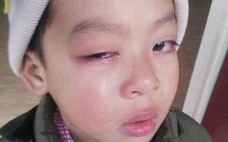 Lạng Sơn: Học sinh có nguy cơ hỏng mắt, nghi do bị cô giáo dùng thước đánh