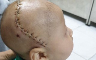 Bé 5 tháng tuổi bị dị tật hộp sọ hiếm gặp