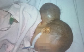 Bé gái mắc bệnh hiếm bị gia đình bỏ rơi tại bệnh viện