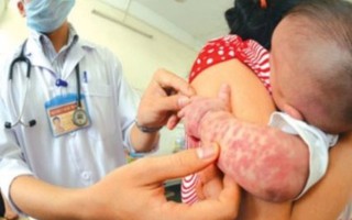 Hà Nội: Bệnh sởi tăng hơn 14 lần so với cùng kỳ 2018
