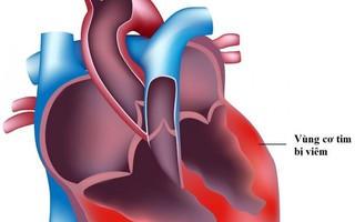 Bộ Y tế lên tiếng về virus lây lan bệnh Viêm cơ tim