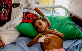 Bé gái gây chấn động thế giới về nạn đói ở Yemen đã qua đời