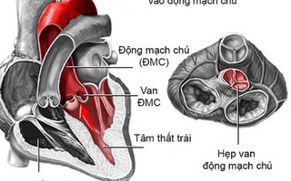 Sản phụ vừa mang thai, vừa mang khối u 4kg