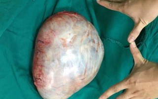 BV huyện phẫu thuật khối u buồng trứng nặng 3,7kg