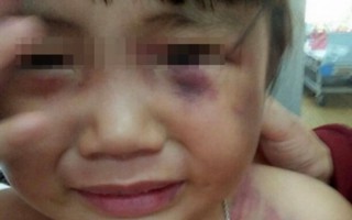 Bé gái 3 tuổi bị chồng hờ của mẹ đánh dã man