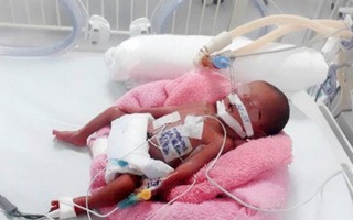 Cứu sống bé gái sinh non 24 tuần, nặng 600 gram trong tình trạng nguy kịch