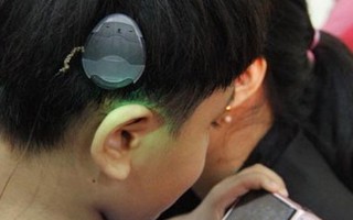 Cơ hội trẻ nghe kém được cấy ốc tai điện tử miễn phí