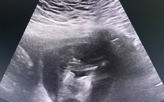 Phát hiện thai phụ mang song thai dính liền chỉ có một quả tim