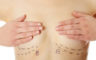 Hoang mang nâng ngực có thể gây ung thư